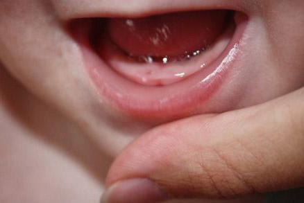 Прорезывание зубов у новорожденных